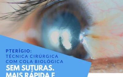 Pterígio: Técnica Cirúrgica com cola biológica