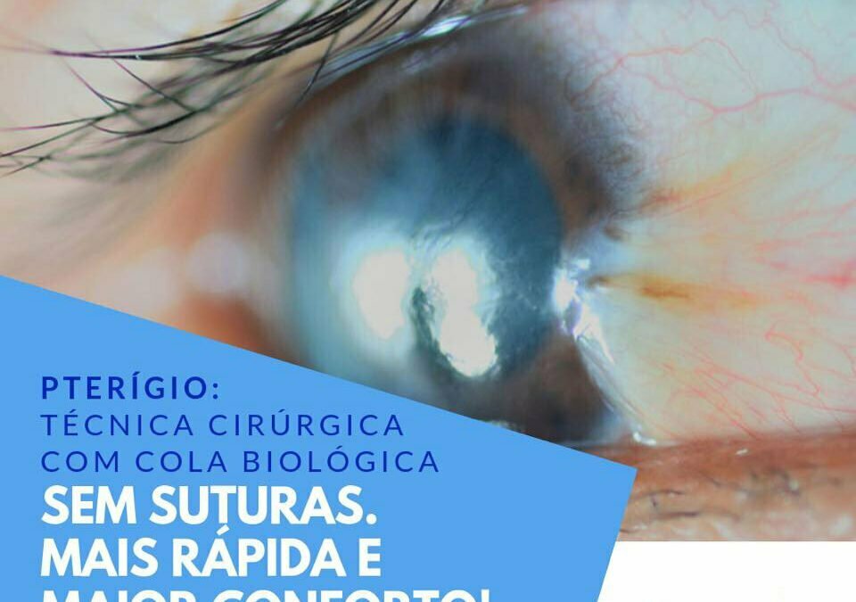 Pterígio: Técnica Cirúrgica com cola biológica