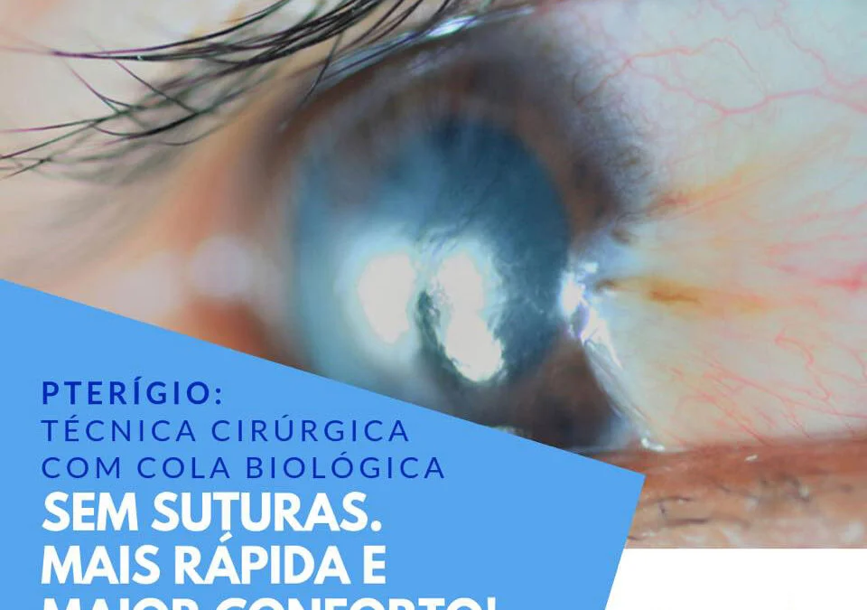 Pterígio: Técnica Cirúrgica com cola biológica